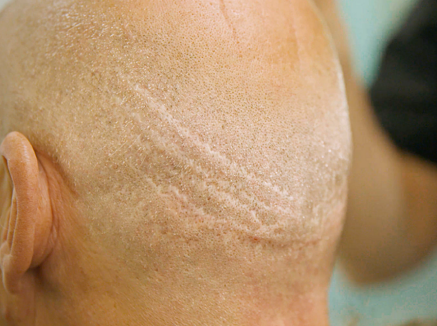 Why so many men are getting botched hair transplants